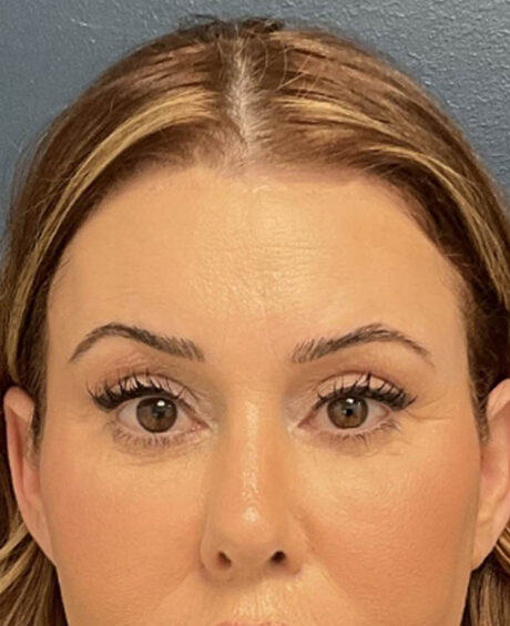 Brow lift case #20028