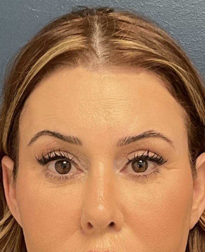 Brow lift case #20028