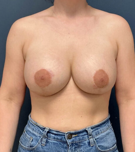 Breast Augmentation case #20136