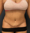 Tummy Tuck case #20062