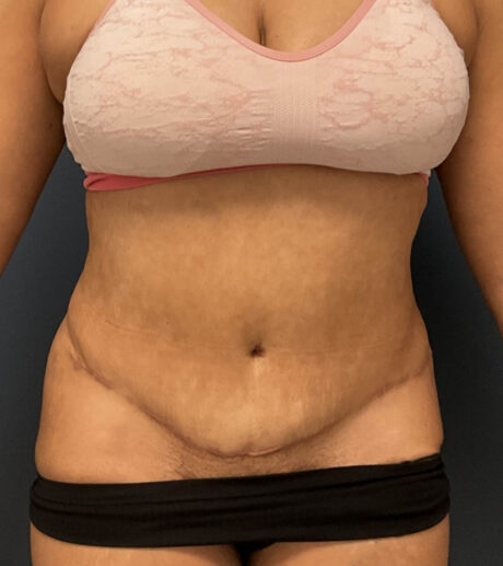 Tummy Tuck case #20062