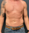 Liposuction case #20110