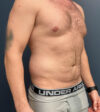 Liposuction case #20110