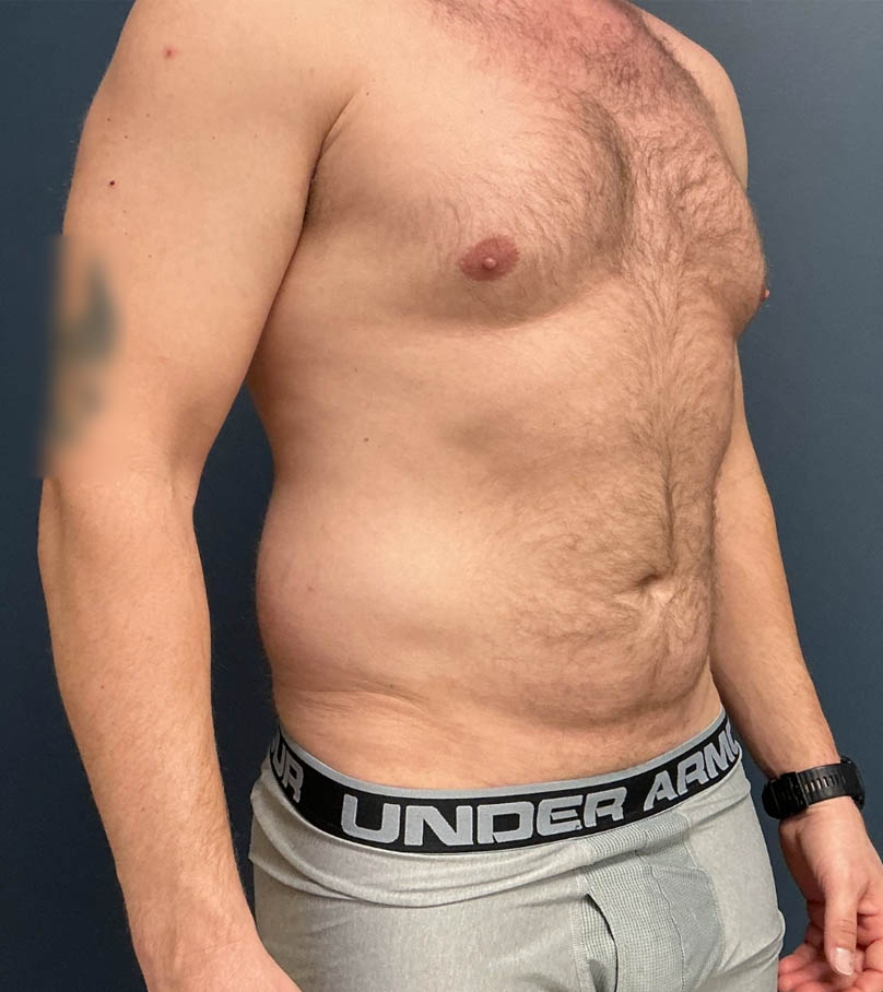 Liposuction case #20110