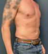 Liposuction case #20110