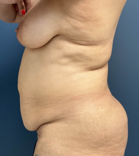 Tummy Tuck case #20062