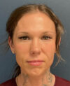 Eyelid Surgery case #20159