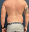 Liposuction case #20110