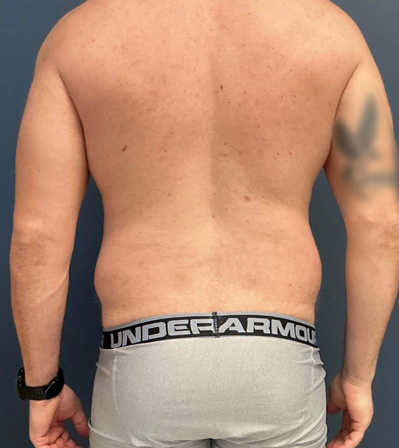 Liposuction case #20110
