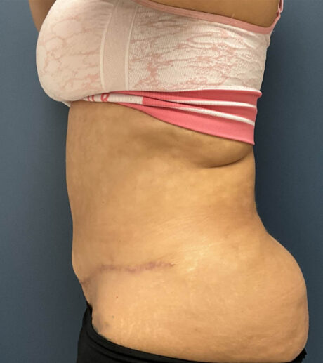 Tummy Tuck case #20062