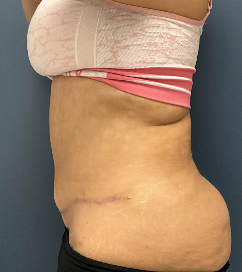 Tummy Tuck case #20062