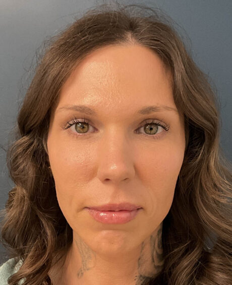 Eyelid Surgery case #20159