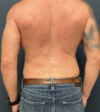 Liposuction case #20110