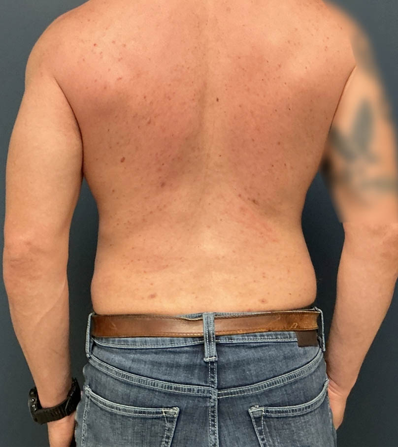 Liposuction case #20110