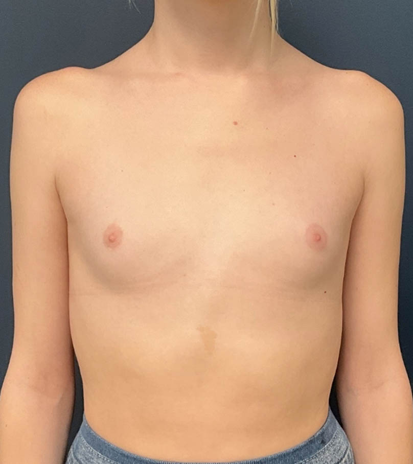 Breast Augmentation case #20129