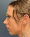 Eyelid Surgery case #20159