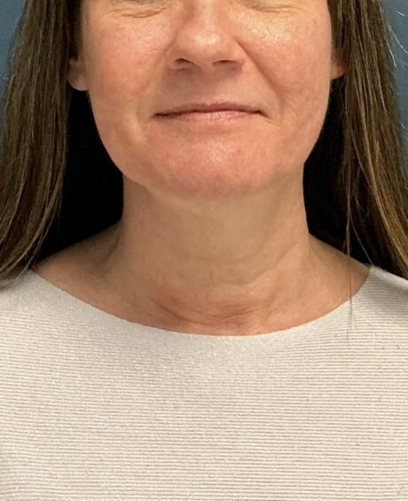 Neck Lift case #20035