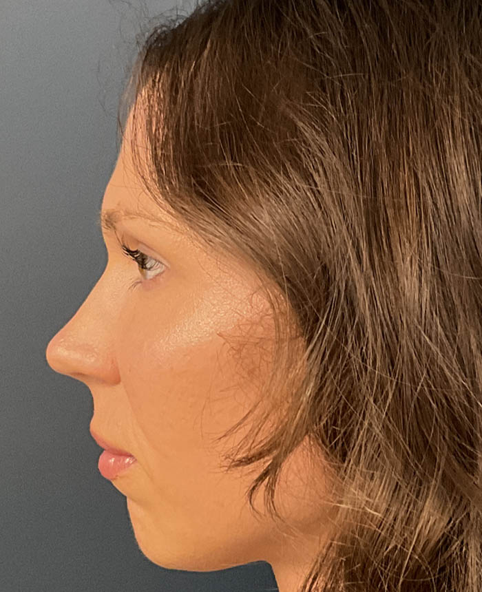Eyelid Surgery case #20159