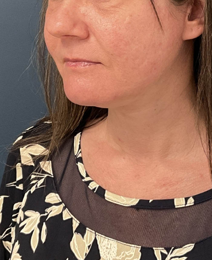 Neck Lift case #20035