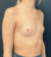 Breast Augmentation case #20129