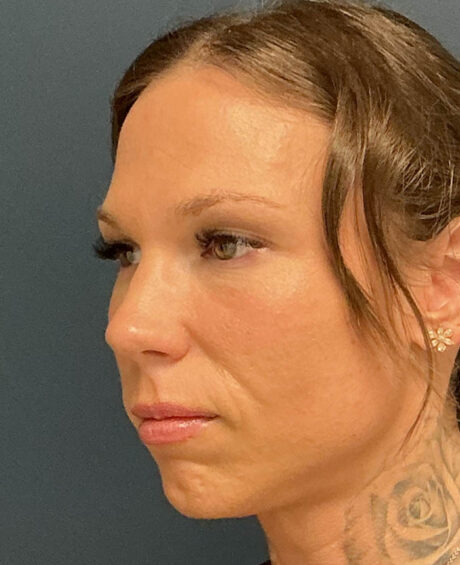 Eyelid Surgery case #20159
