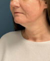 Neck Lift case #20035