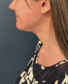 Neck Lift case #20035