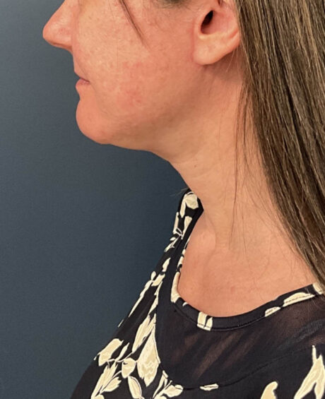 Neck Lift case #20035