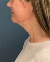 Neck Lift case #20035