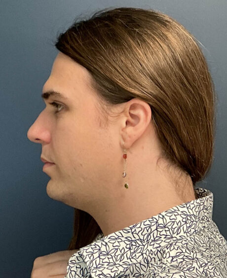 Facial Feminization Surgery case #20152