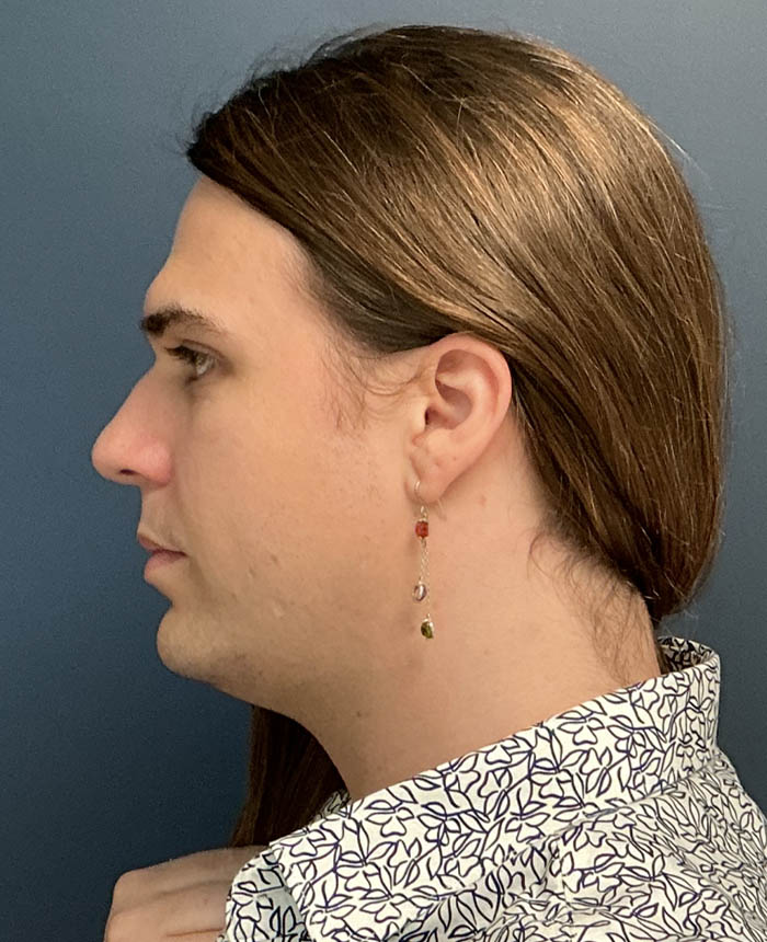 Facial Feminization Surgery case #20152