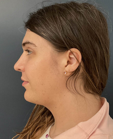 Facial Feminization Surgery case #20152