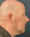 Eyelid Surgery case #20055