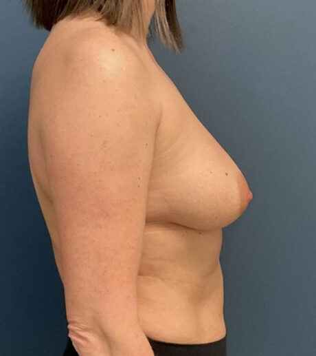 Breast Augmentation With Lift case #20117