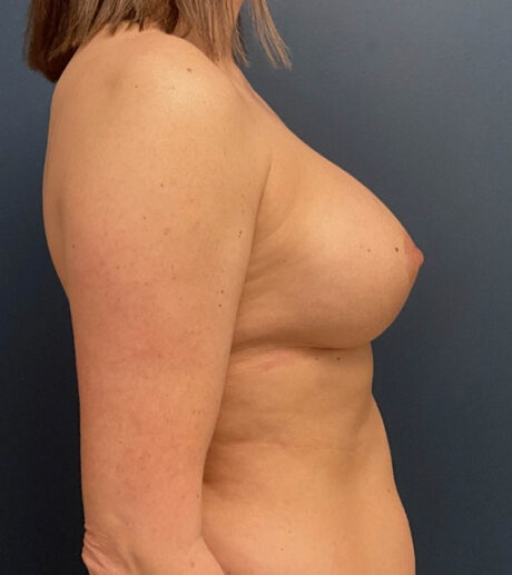Breast Augmentation With Lift case #20117