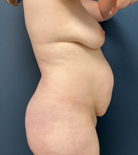 Tummy Tuck case #20092