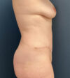 Tummy Tuck case #20092