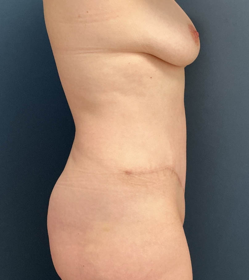 Tummy Tuck case #20092