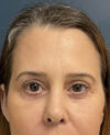 Eyelid Surgery case #20028
