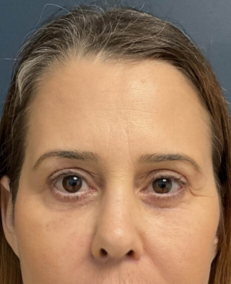 Eyelid Surgery case #20028