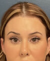 Eyelid Surgery case #20028