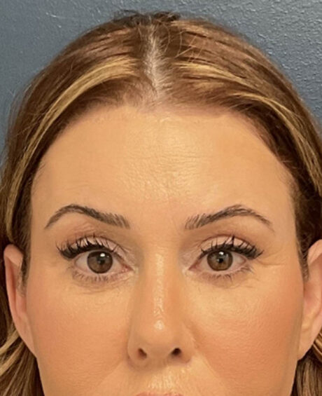 Eyelid Surgery case #20028