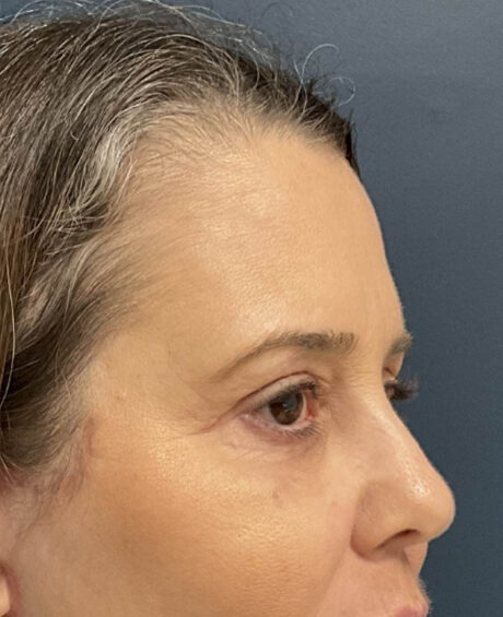 Eyelid Surgery case #20028