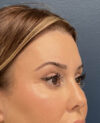 Eyelid Surgery case #20028