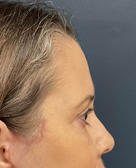 Eyelid Surgery case #20028