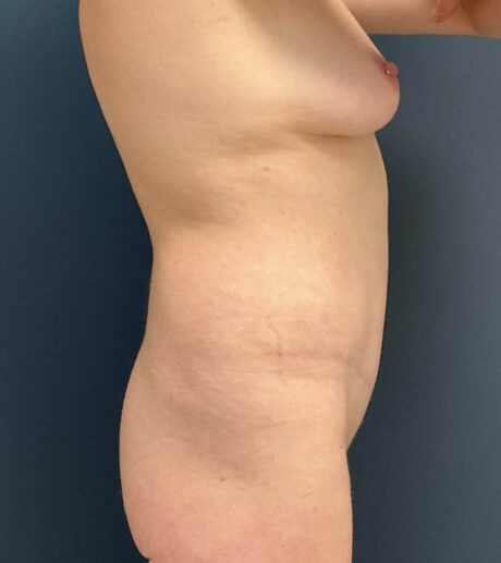 Tummy Tuck case #20103