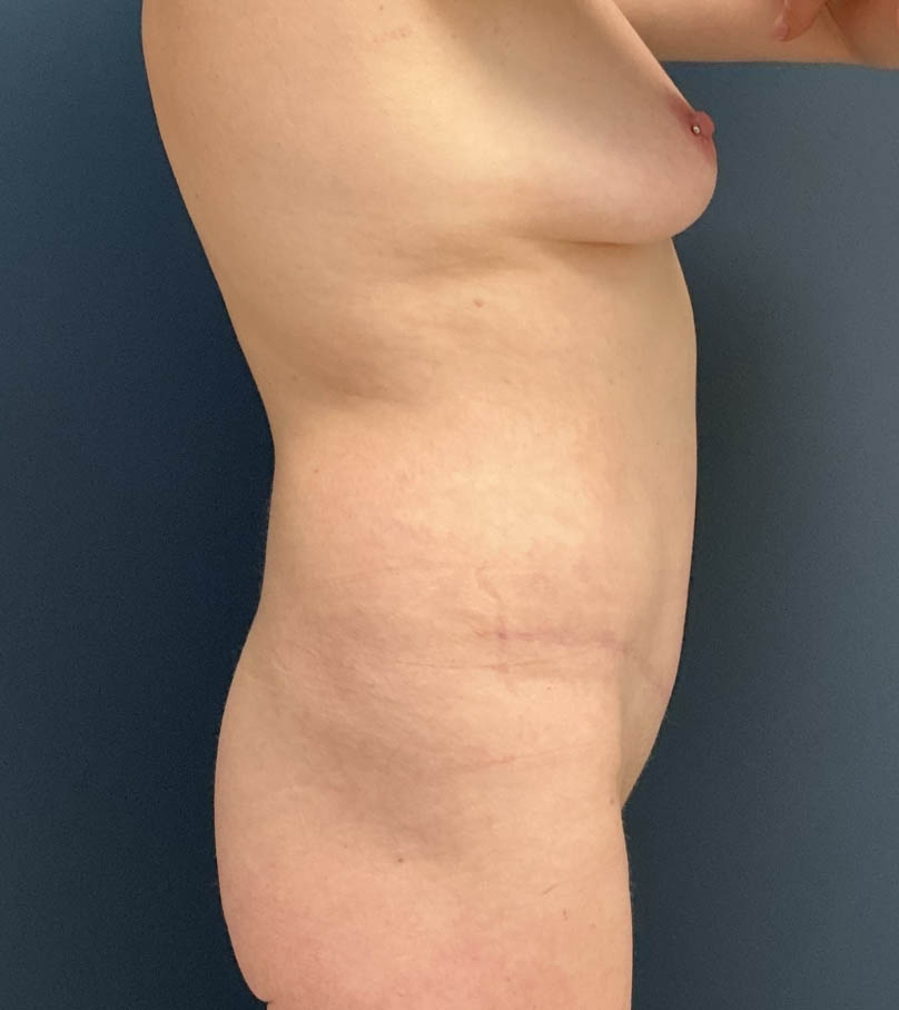 Tummy Tuck case #20103