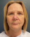 Facelift case #20023