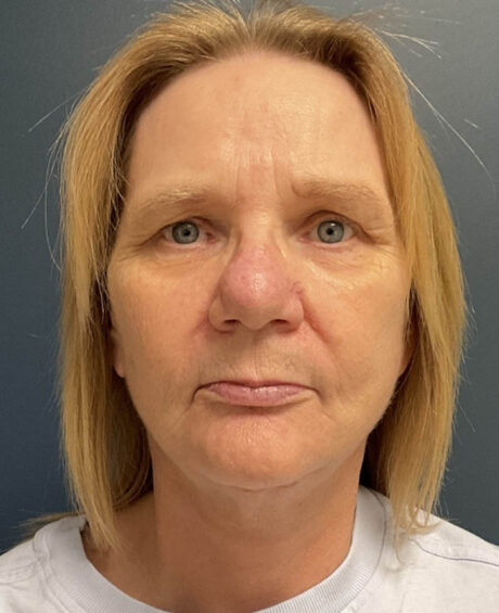 Facelift case #20023