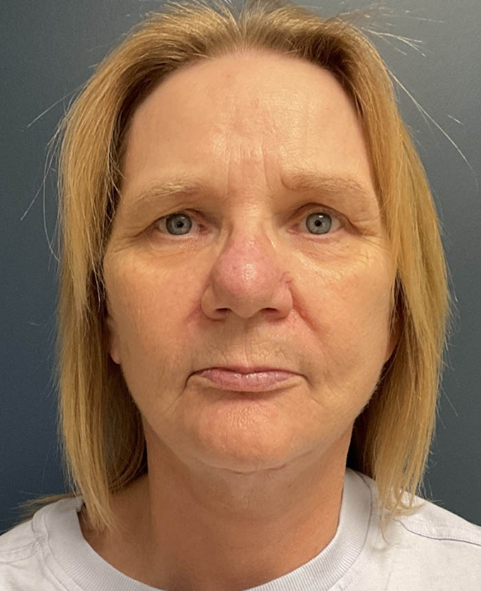 Facelift case #20023